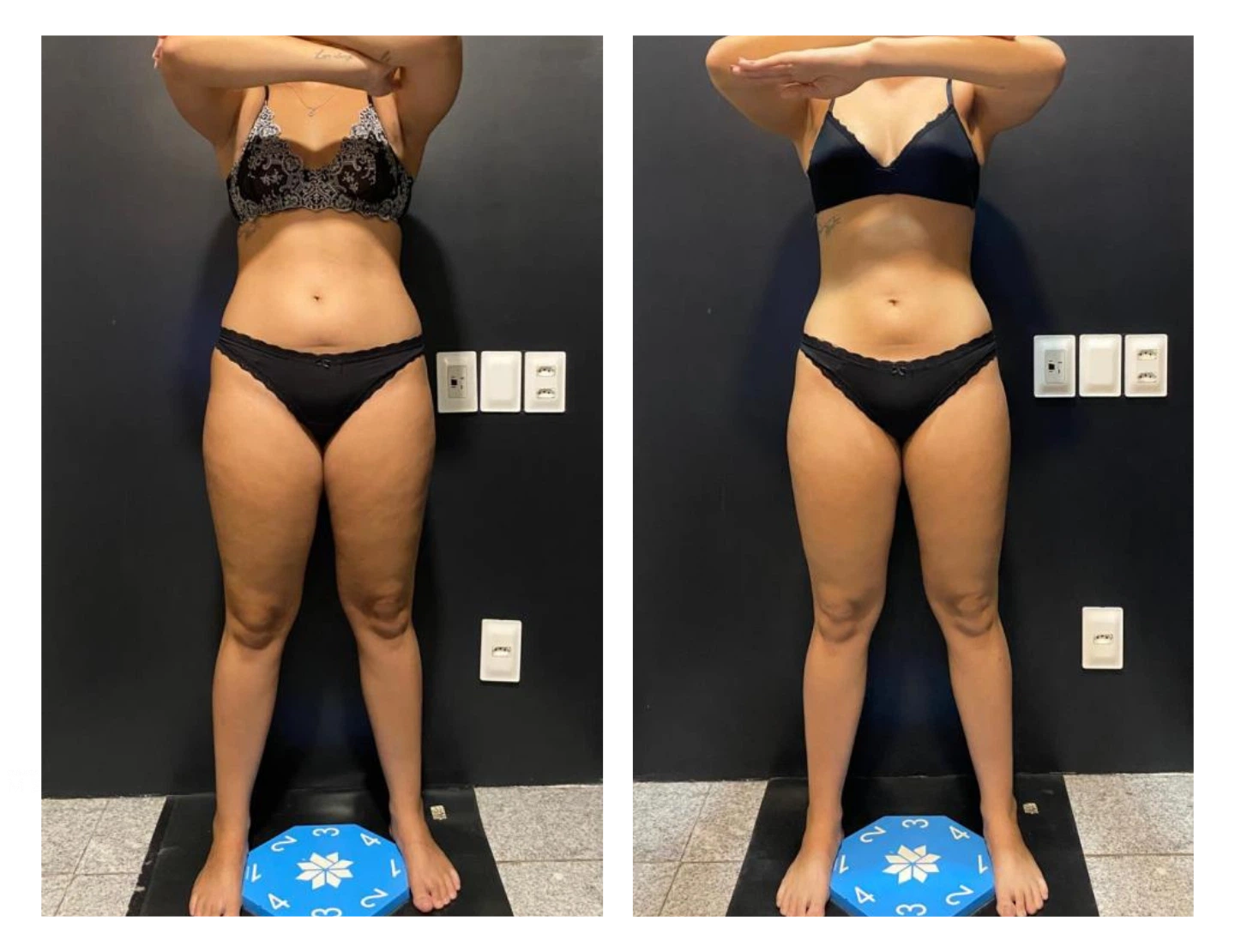 antes-e-depois-4-dr-diego-pascaretta-medico-nutrologo-especialista-em-saude-metaabolica-reposicao-hormonal-e-protocolos-personaizados-de-alta-performance- (1)