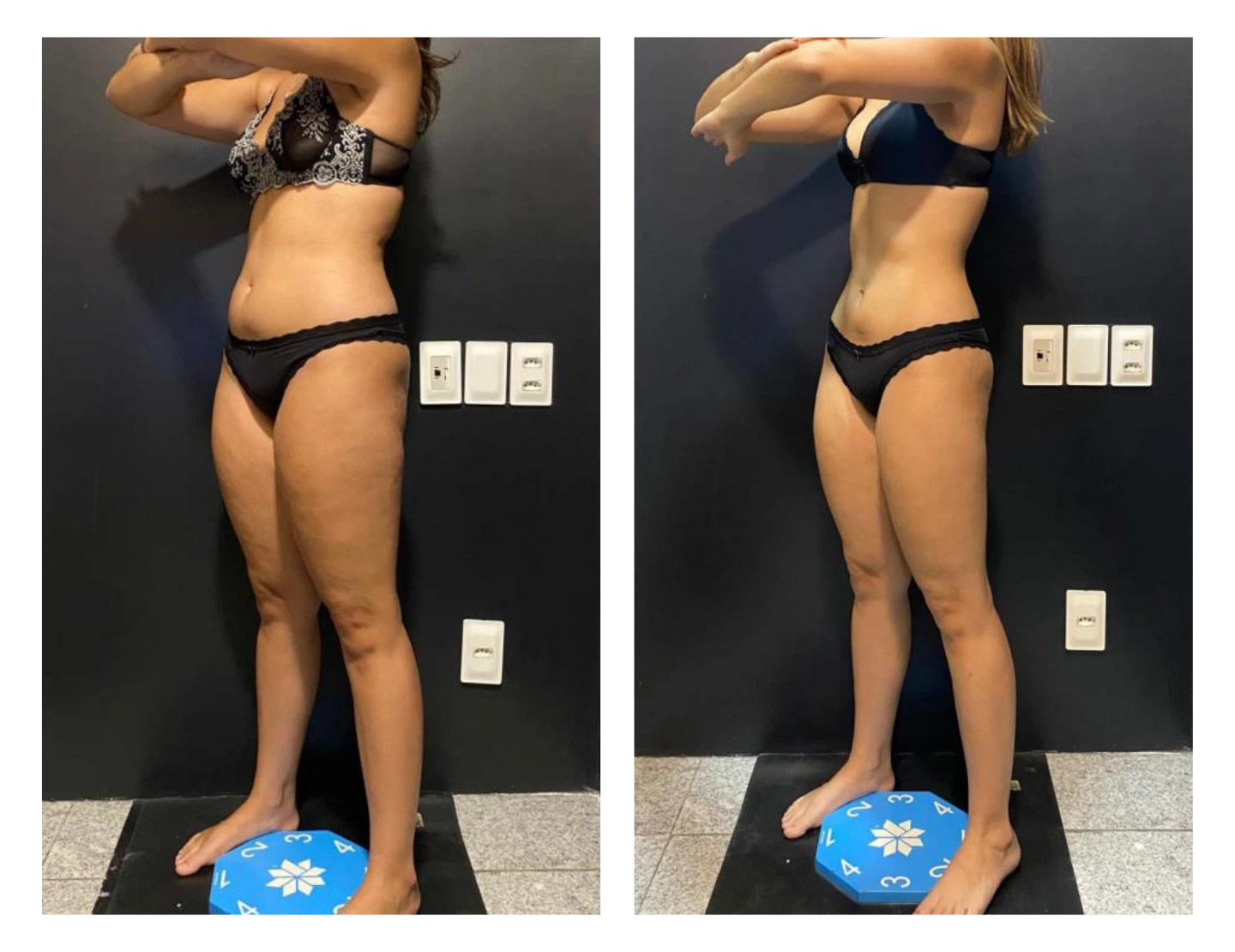 antes-e-depois-5-dr-diego-pascaretta-medico-nutrologo-especialista-em-saude-metaabolica-reposicao-hormonal-e-protocolos-personaizados-de-alta-performance- (1)