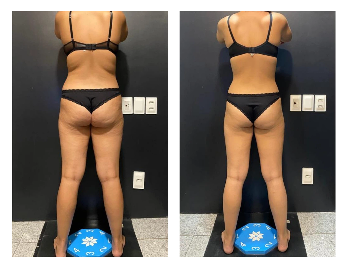 antes-e-depois-7-dr-diego-pascaretta-medico-nutrologo-especialista-em-saude-metaabolica-reposicao-hormonal-e-protocolos-personaizados-de-alta-performance- (1)