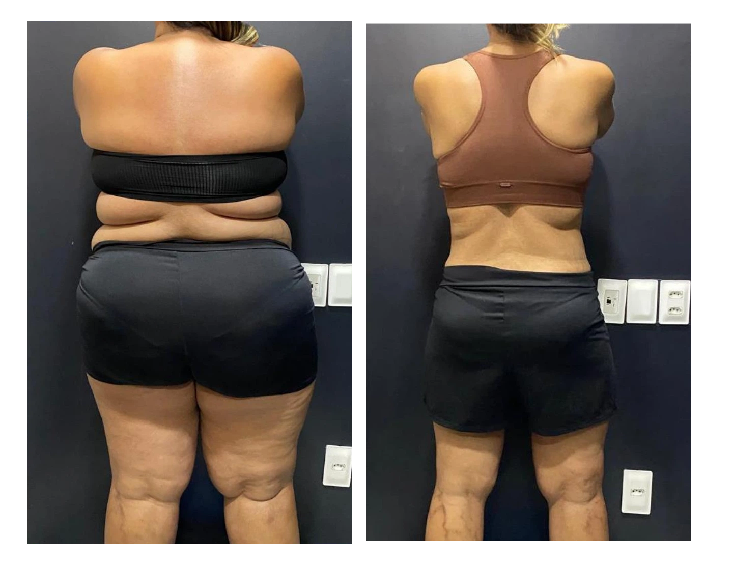 kaliny-suzany-antes-e-depois-10-dr-diego-pascaretta-medico-nutrologo-especialista-em-saude-metaabolica-reposicao-hormonal-e-protocolos-personaizados-de-alta-performance-