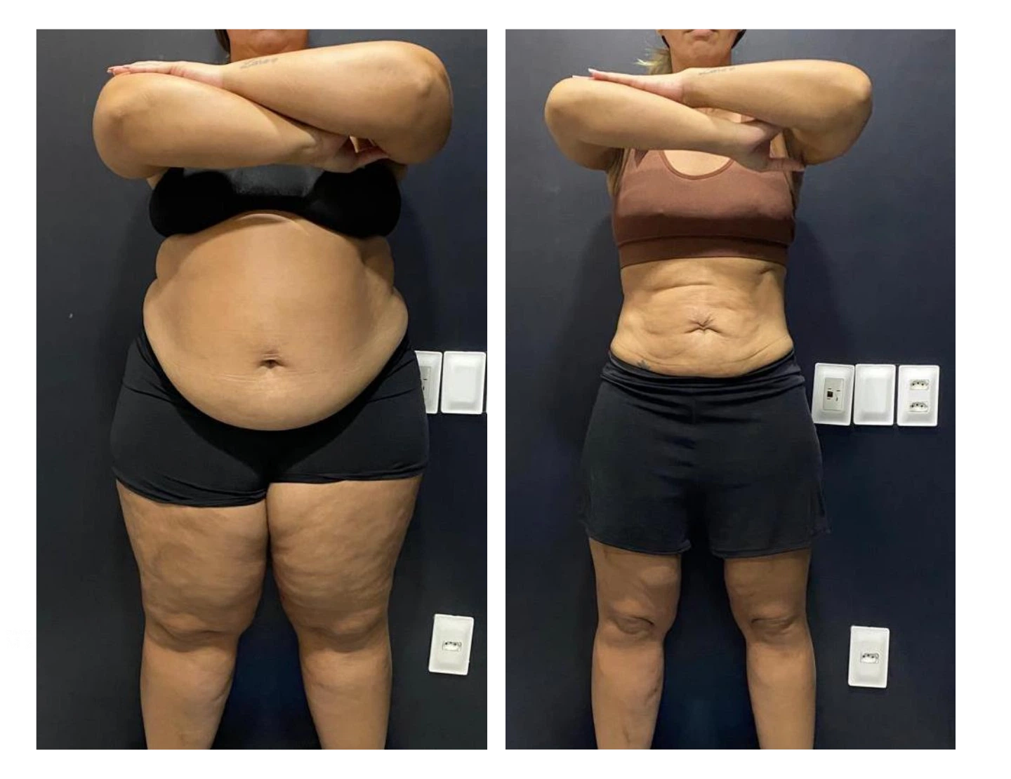 kaliny-suzany-antes-e-depois-7-dr-diego-pascaretta-medico-nutrologo-especialista-em-saude-metaabolica-reposicao-hormonal-e-protocolos-personaizados-de-alta-performance-