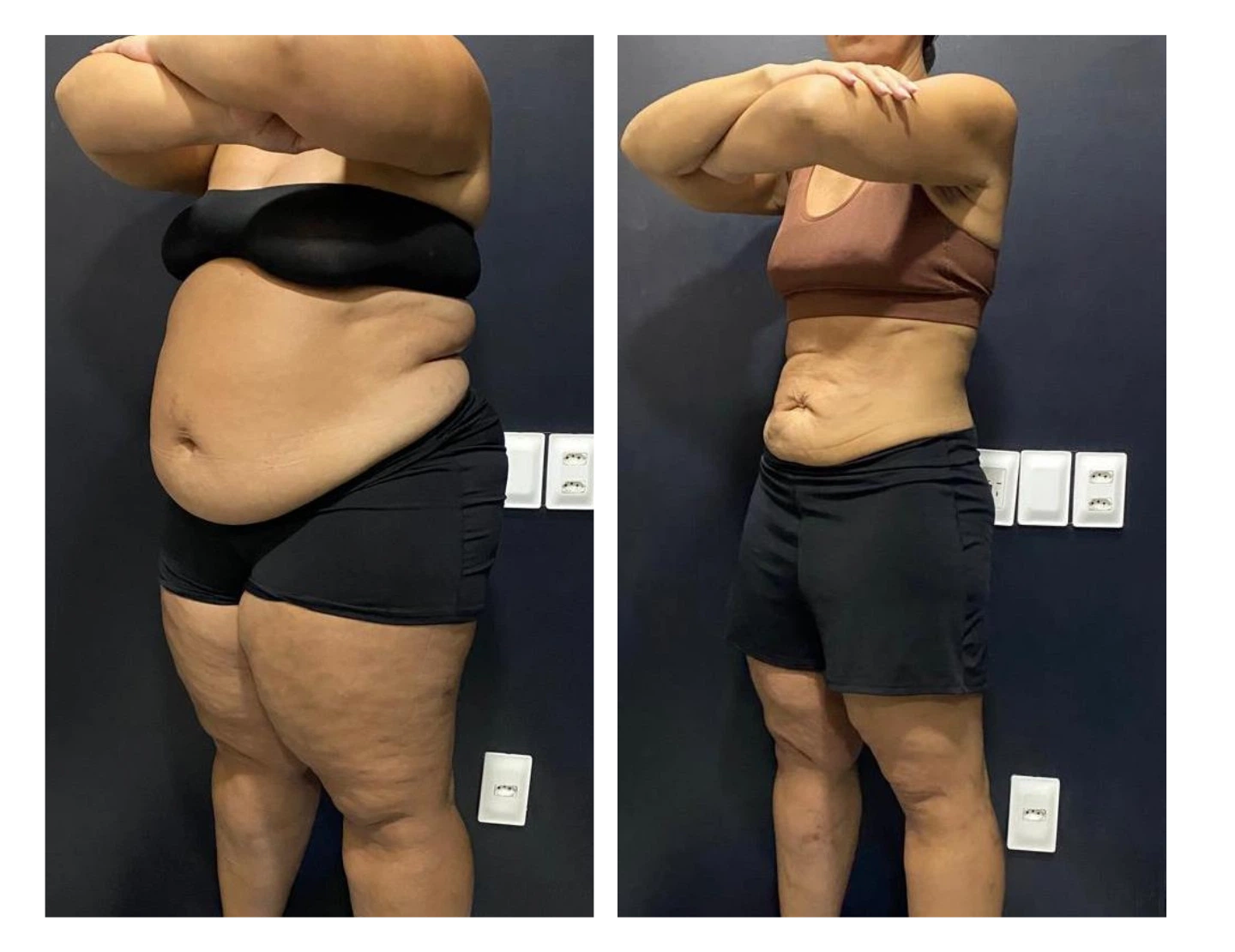 kaliny-suzany-antes-e-depois-8-dr-diego-pascaretta-medico-nutrologo-especialista-em-saude-metaabolica-reposicao-hormonal-e-protocolos-personaizados-de-alta-performance-